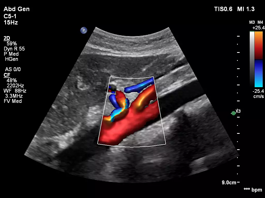 philips affiniti 70 ultrasound clinical image