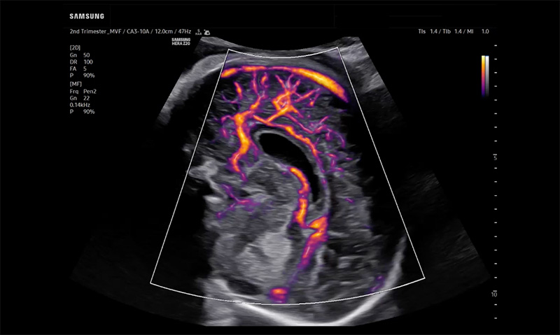 samsung hera z20 clinical image